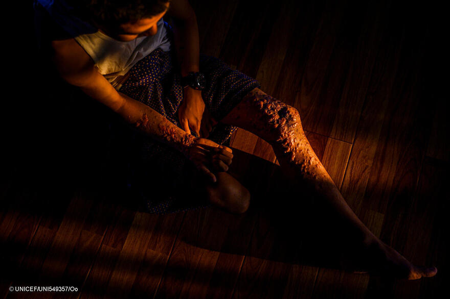 Paing, de 14 años, del estado de Kayah, pisó una mina terrestre mientras buscaba a la vaca herida de su familia en una granja del vecindario, al este de Myanmar. 