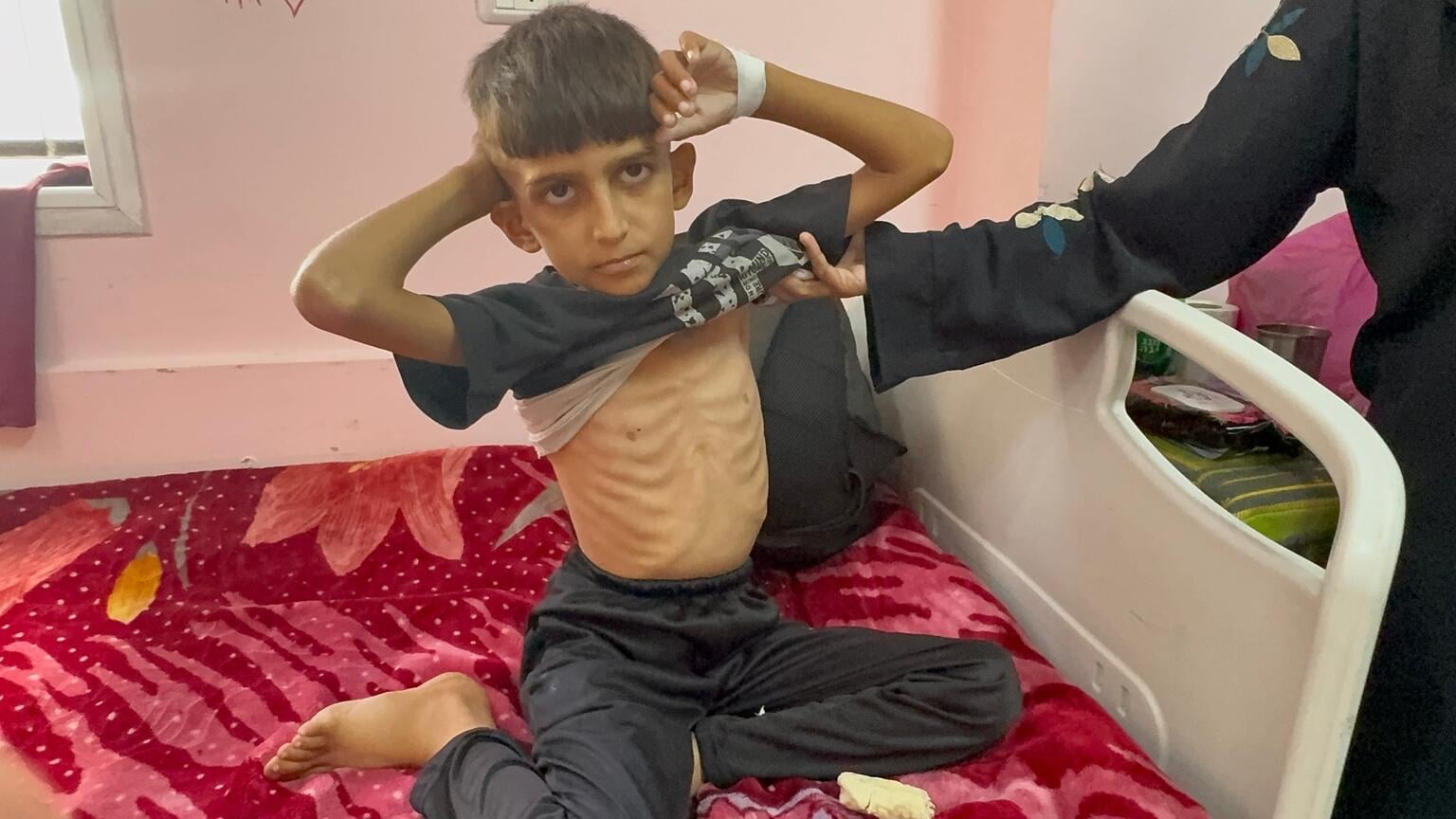niño con desnutrición aguda en Gaza, con las costillas marcadas