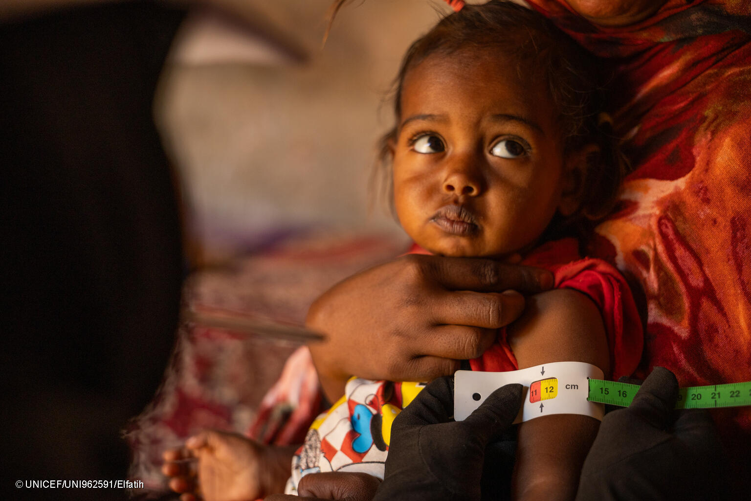 niña con desnutrición por el conflicto en Sudán
