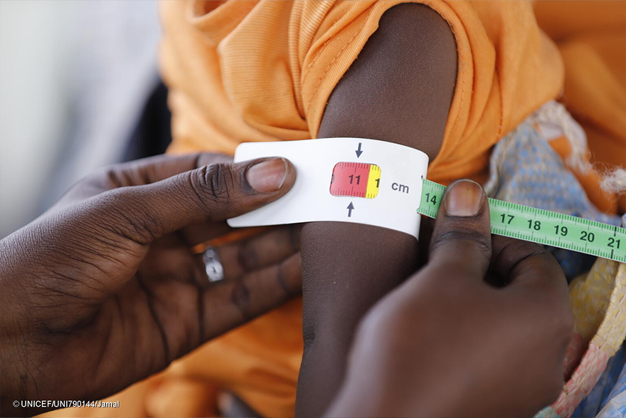 Un niño con desnutrición aguda grave