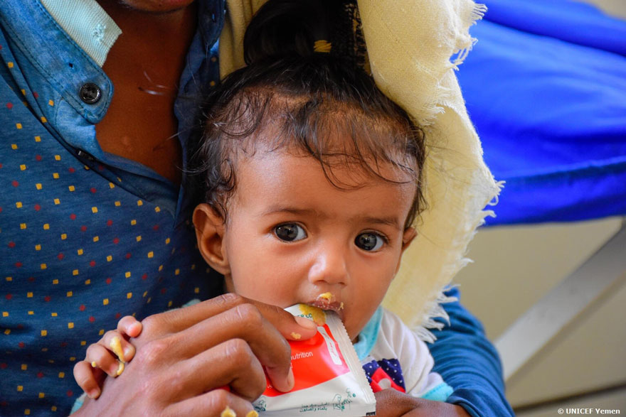Una niña recibe alimento terapéutico contra la desnutrición en Yemen