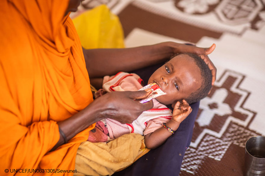 Un niño recibe tratamiento contra la desnutrición en un campo de desplazados de Etiopía