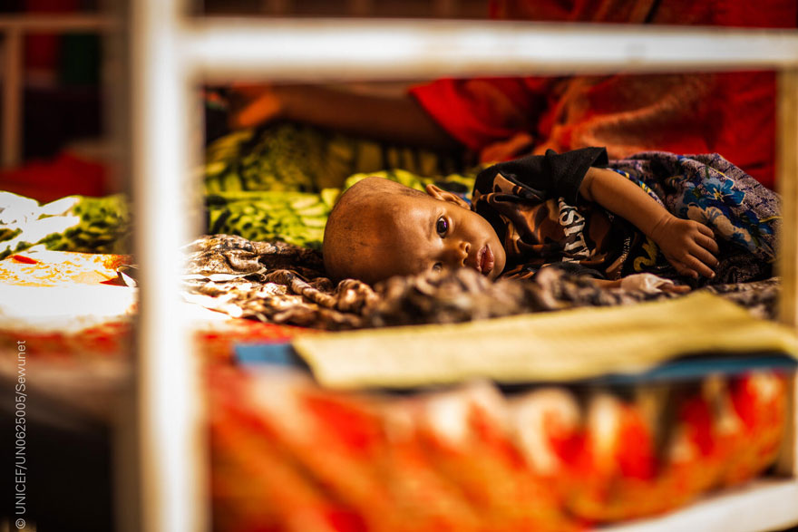 Un bebé gravemente desnutrido recibe tratamiento en el Hospital Gode, en Etiopía