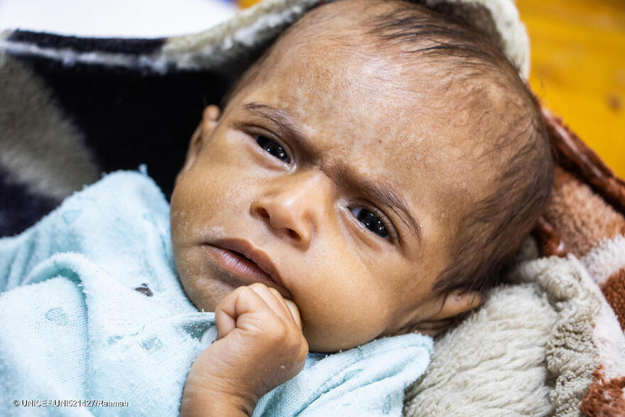 El bebé Ali Mohammed, de siete meses, en el Centro de Alimentación Terapéutica del Hospital General Al-Talh, en el distrito de Sahar, gobernación de Saada.