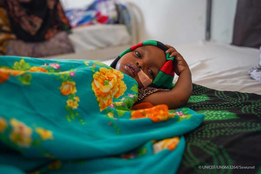 Un niño con desnutrición aguda grave en Somalia