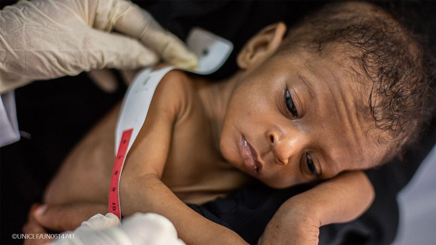 Un niño yemení sufre los efectos de la desnutrición