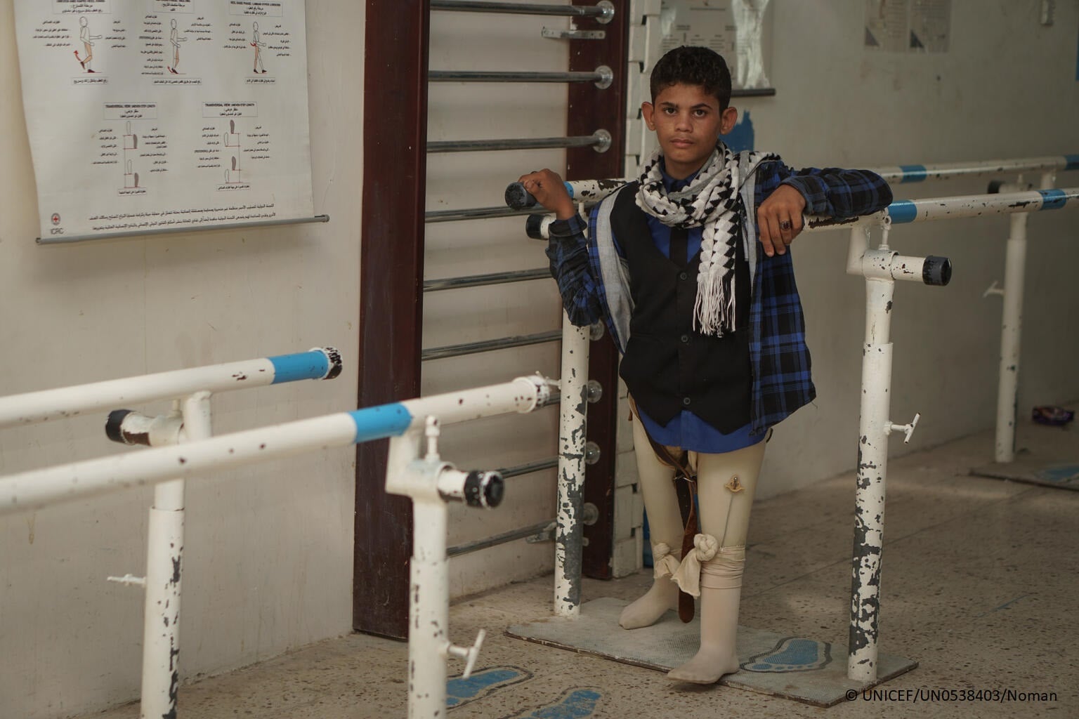 Niño mutilado por una mina en Yemen