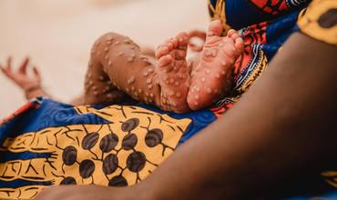 Aline, de 1 mes, en brazos de su madre en la unidad de aislamiento para mpox del Hospital Kamanyola, respaldado por UNICEF, en la provincia de Kivu del Sur, República Democrática del Congo, el 24 de julio de 2024