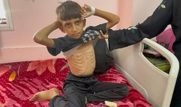 niño con desnutrición aguda en Gaza, con las costillas marcadas