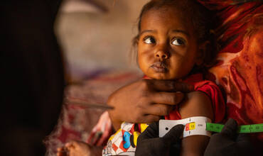 niña con desnutrición por el conflicto en Sudán