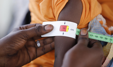 Un niño con desnutrición aguda grave