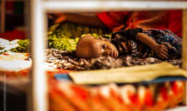 Un bebé gravemente desnutrido recibe tratamiento en el Hospital Gode, en Etiopía