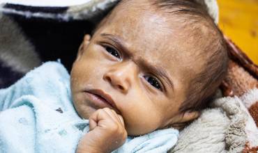 El bebé Ali Mohammed, de siete meses, en el Centro de Alimentación Terapéutica del Hospital General Al-Talh, en el distrito de Sahar, gobernación de Saada.