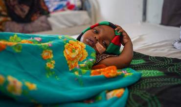Un niño con desnutrición aguda grave en Somalia