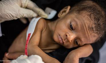 Un niño yemení sufre los efectos de la desnutrición