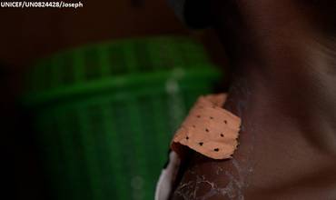 Hombro de una niña haitiana herida a causa de la violencia en su país