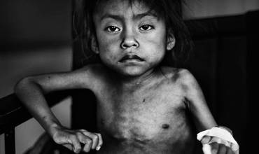 Guatemala: marcada por la desnutrición