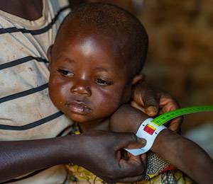 Nabitu usa una cinta MUAC en su hija Anita, de 2 años. Nabitu usa una cinta MUAC en su hija Anita, de 2 años.