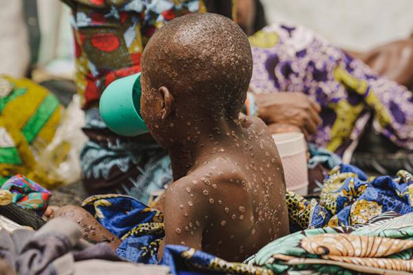 Niño contagiado de mpox