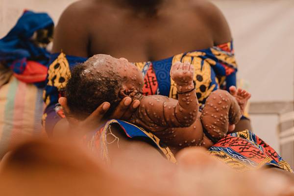 Un bebé de un mes contagiado de mpox