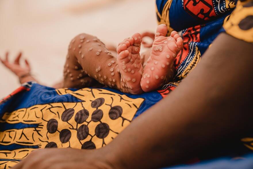  Aline, de 1 mes, en brazos de su madre en la unidad de aislamiento para mpox del Hospital Kamanyola, respaldado por UNICEF, en la provincia de Kivu del Sur, República Democrática del Congo, el 24 de julio de 2024.