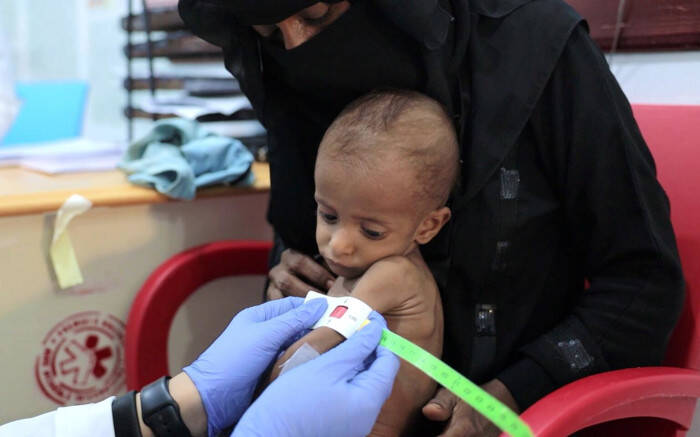 Desnutrición en niños en conflictos.
