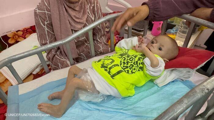 Una niña con desnutrición aguda grave en un centro hospitalario de Khan Younis, Gaza