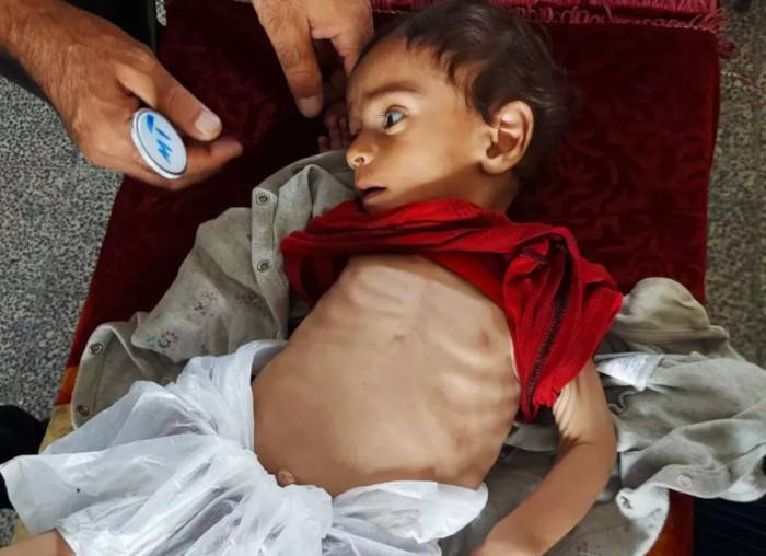 Un niño con desnutrición aguda grave en Gaza.